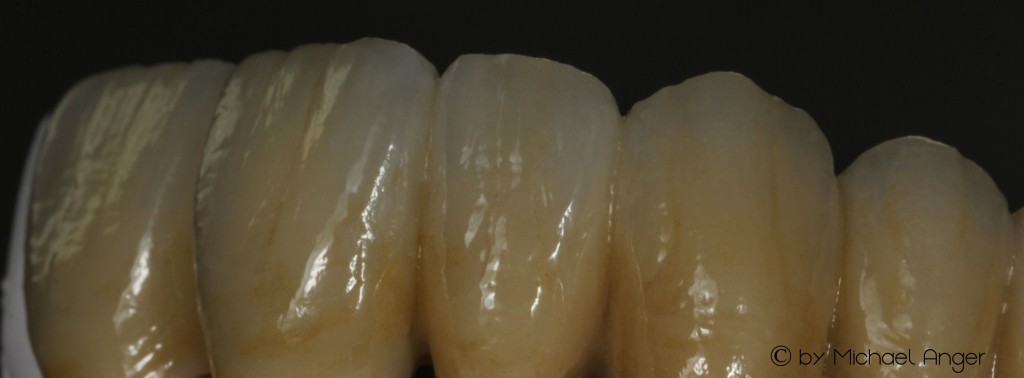 z Tizian Ceramic Keramik Verblendungen Zirkon zirconium-3