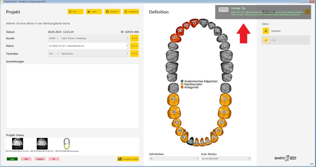 A neues Exocad im Win8_Design 3. Workflow-Hotkey
