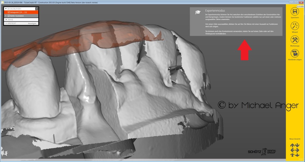 A neues Exocad im Win8_Design 5.CAD Modellation Expert-Modus