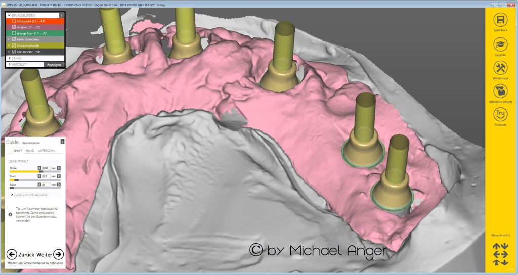 A12 New Exocad Modellation Implants individual Screwchannels
