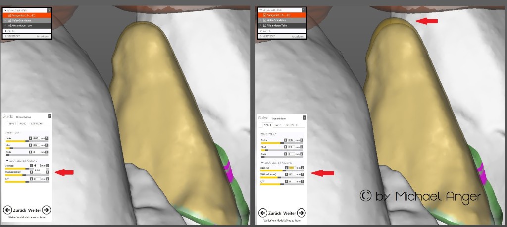AAA neues Exocad im Win8_Design 8.CAD Modellation Workflow zusätzlicher Abstand okklusal