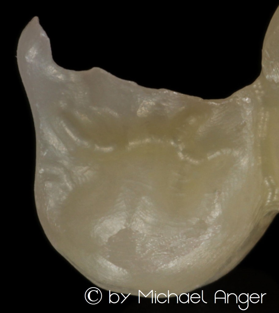High transulcent zirconium Hochtransluzentes Zirkon 2 Detail 1
