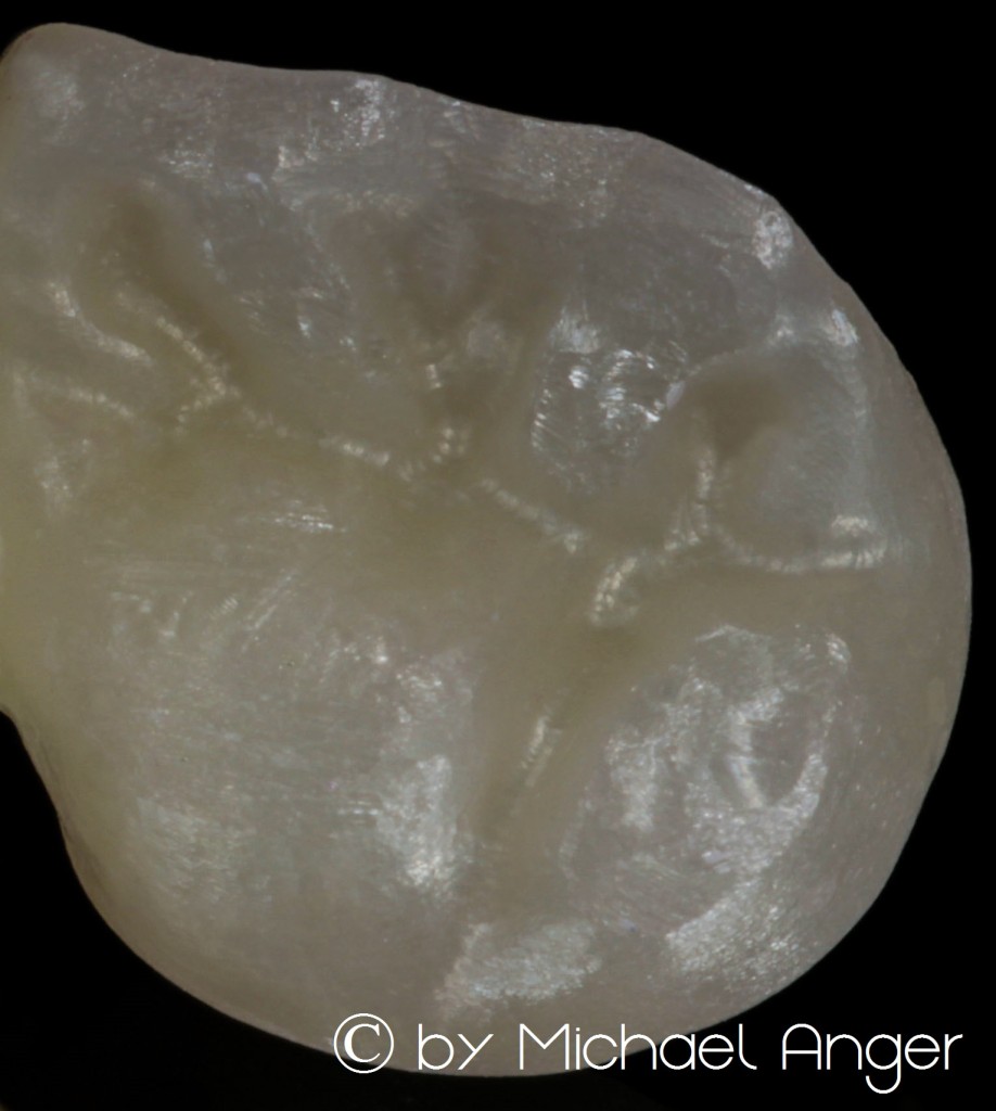 High transulcent zirconium Hochtransluzentes Zirkon 2 Detail 2