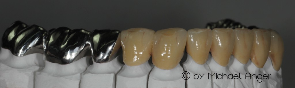 Rohbrand CAD-CAM Gerüste Kronen Brücken 1