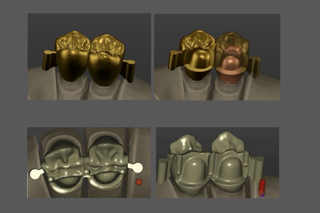 TruSmile Gold Geschiebe Attachments Collage Blanko