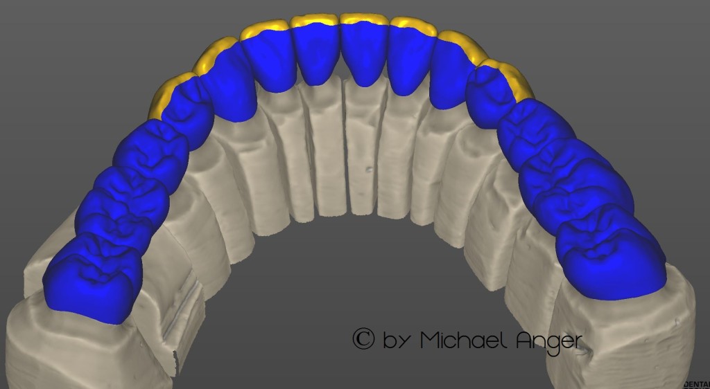Virtuelle Modellation der Anatomie im TruSmile Modus2 Schrumpfen