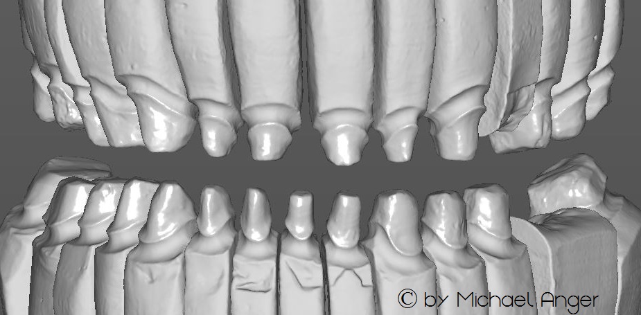 z CADCAM Modellation exocad Frontalansicht