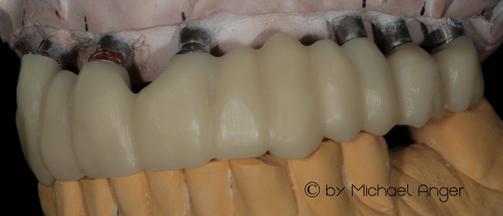 Implant try-in Einprobe provisorisches Gerüst im Artikulator okklusal