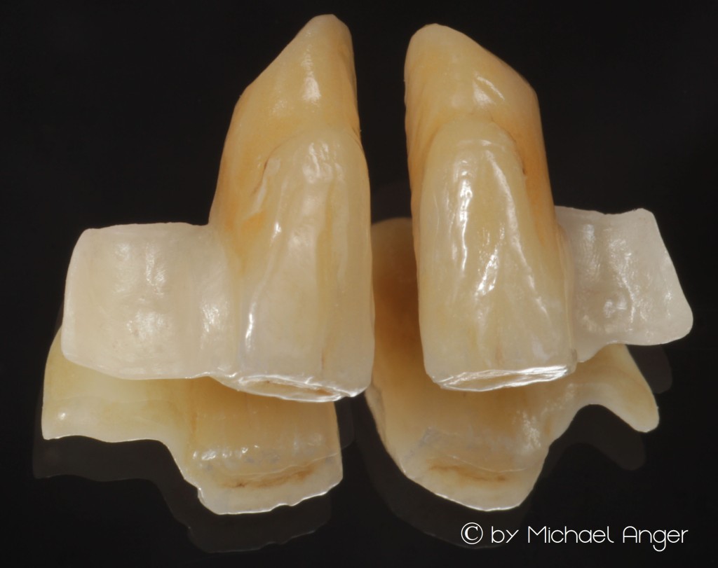 Marylandbrücke Zirkon mit Verblendung auf Spiegel