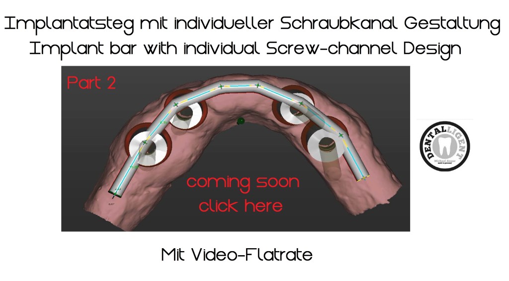 Implantatsteg mit manueller Schraubkanalpositionierung Teil 2 Übersicht