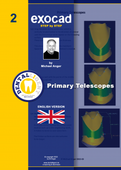 Exocad Step by Step - Nr.2 -Primary Telescopes 