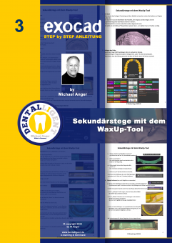 Exocad Step by Step Anleitung - Nr. 3 - Sekundärstege mit Wax-up Tool 