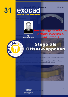 Exocad Step by Step Anleitung -Nr. 31 - Stege als Offset-Käppchen 