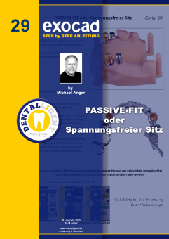 Exocad Step by Step Anleitung - Nr. 29 PASSIVE-FIT oder Spannungsfreier Sitz 