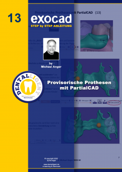 Exocad Step by Step Anleitung - Nr. 13 - Provisorische Prothesen  mit PartialCAD 