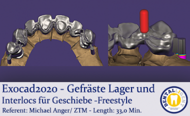 DENTALLIGENT | 2020-Exocad - Gefräste Lager und Interlocs für Geschiebe ...