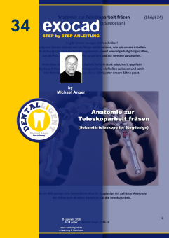 Exocad Step by Step Anleitung -Nr. 34 - Anatomie zur Teleskoparbeit fräsen (Sekundärteleskope im Stegdesign) 