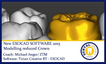 2015-Modelling reduced Crown - Exocad 2015 