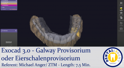 2021-Exocad 3.0 – Galway Provisorium oder Eierschalenprovisorium 