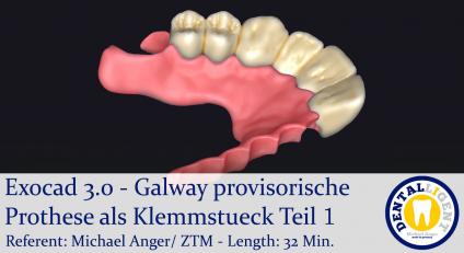2021-Exocad - Exocad 3.0 – Galway provisorische Prothese als Klemmstueck Teil 1 