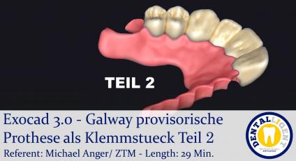 2021-Exocad - Exocad 3.0 – Galway provisorische Prothese als Klemmstueck Teil 2 