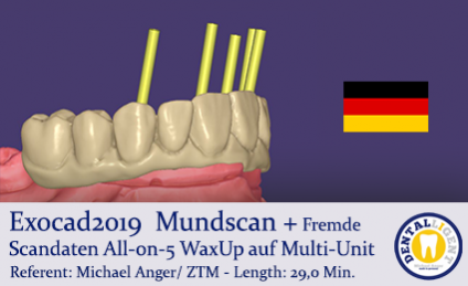2019 - Exocad  Mundscan + Fremde Scandaten All-on-5 WaxUp auf Multi-Unit 