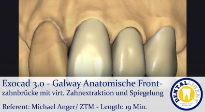 2021-Exocad - Exocad 3.0 – Galway Anatomische Frontzahnbrücke mit virtueller Zahnextraktion und Spiegelung 