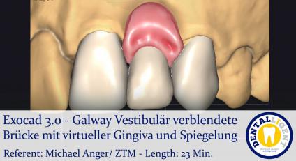 2021-Exocad - Exocad 3.0 – Galway Vestibulär verblendete Brücke mit virtueller Gingiva und Spiegelung 