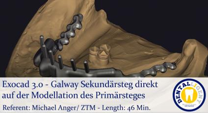 2021-Exocad - Exocad 3.0 – Galway Sekundärsteg direkt auf der Modellation des Primärsteges 