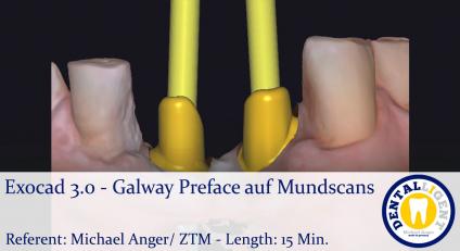 2021-Exocad - Exocad 3.0 – Galway Preface auf Mundscans 