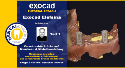 Exocad Elefsina 2024-3 Teil 1 Verschraubte Brücke auf Mundscan & Modellherstellung 
