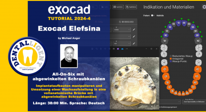 Exocad Elefsina 2024-4 All-On-Six mit abgewinkelten Schraubkanälen 