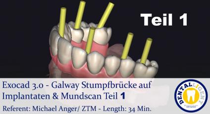 2021-Exocad - Exocad 3.0 – Galway Stumpfbrücke auf Implantaten & Mundscan Teil 1 