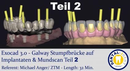 2021-Exocad - Exocad 3.0 – Galway Stumpfbrücke auf Implantaten & Mundscan Teil 2 