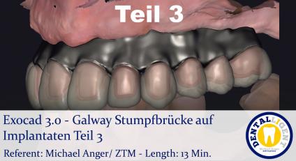 2021-Exocad - Exocad 3.0 – Galway Stumpfbrücke auf Implantaten & Mundscan Teil 3 