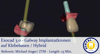 2021-Exocad - Exocad 3.0 – Galway Galway Implantatkronen auf Klebebasen / Hybrid 
