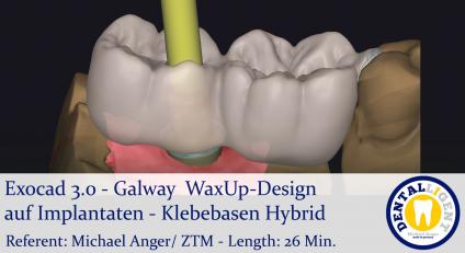 2021-Exocad - Exocad 3.0 – GalwayWaxUp-Design auf Implantaten - Klebebasen Hybrid 