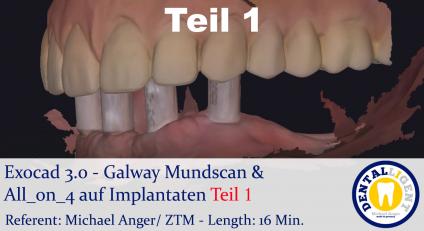 2021-Exocad 3.0 – Galway Mundscan & All_on_4 auf Implantaten Teil1 
