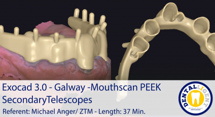 2021-Exocad 3.0 – Galway  Mouthscan PEEK Secondary Telescopes 