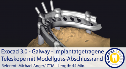 2021-Exocad - Exocad 3.0 – Galway Implantatgetragene Teleskope mit Modellguss-Abschlussrand 