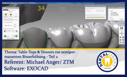Table-Tops & Veneers zur semipermanenten Bisserhöhung Teil 2 
