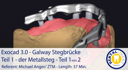 2021-Exocad 3.0 – Galway Stegbrücke Teil 1 - der Metallsteg - Teil 1 von 2 