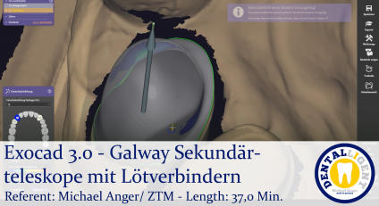 2021-Exocad - Exocad 3.0 - Galway Sekundärteleskope mit Lötverbindern 