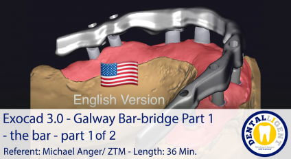 2021-Exocad - Exocad 3.0 – Galway Bar-bridge Part 1 - the bar - part 1 of 2 
