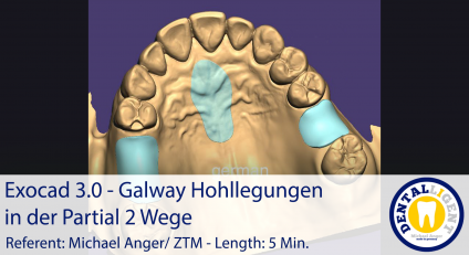 2021-Exocad 3.0 –  Galway Hohllegungen in der Partial 2 Wege 