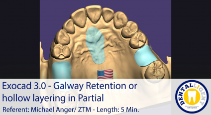 2021-Exocad 3.0 – Galway Retention or hollow layering in Partial 