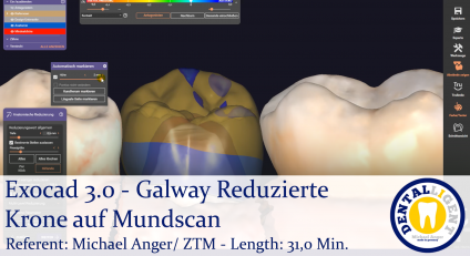 2021-Exocad - Exocad 3.0 – Galway Reduzierte Krone auf Mundscan 