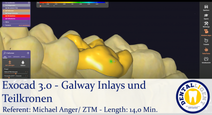 2021-Exocad - Exocad 3.0 – Galway Inlays und Teilkronen 