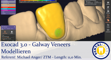 2021-Exocad - Exocad 3.0 – Galway Veneers Modellieren 