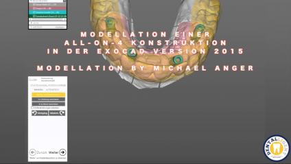 GRATIS - Modellation einer All-On-4 Konstruktion aus CoCr 